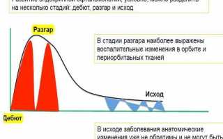 Эндокринная офтальмопатия: лечение, симптомы, код по МКБ-10, фото