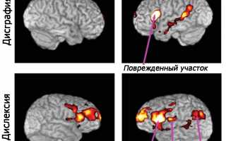 Причины, симптомы и лечение дисграфии у детей