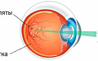 Лазерная коагуляция сетчатки глаза: цена, послеоперационный период, последствия