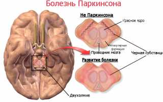 Причины, классификация и терапия паркинсонизма