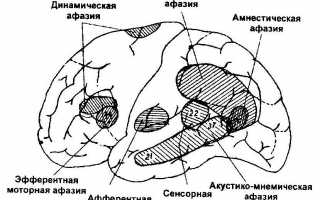 Виды и симптомы афазии