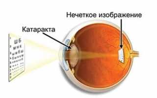 Катаракта: причины, симптомы, лечение и профилактика