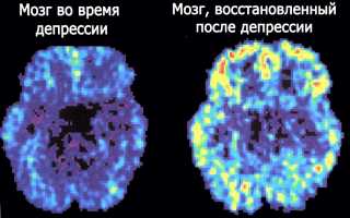 Причины, симптомы и методы лечения маниакальной депрессии