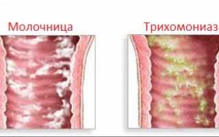 Как отличить молочницу от трихомониаза?