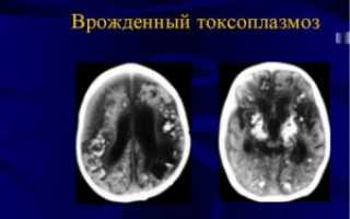 Как развивается токсоплазмоз у взрослых?