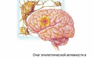 Симптомы фокальной эпилепсии, диагностика и лечение