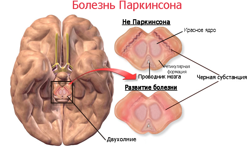 Рисунок, отражающий изменения в головном мозге человека при болезни Паркинсона