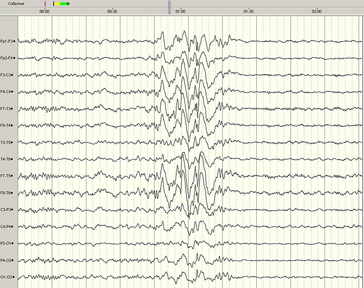 ЭЭГ больного К., с диагнозом: Симптоматическая эпилепсия, сложные парциальные припадки с вторичной генерализацией.