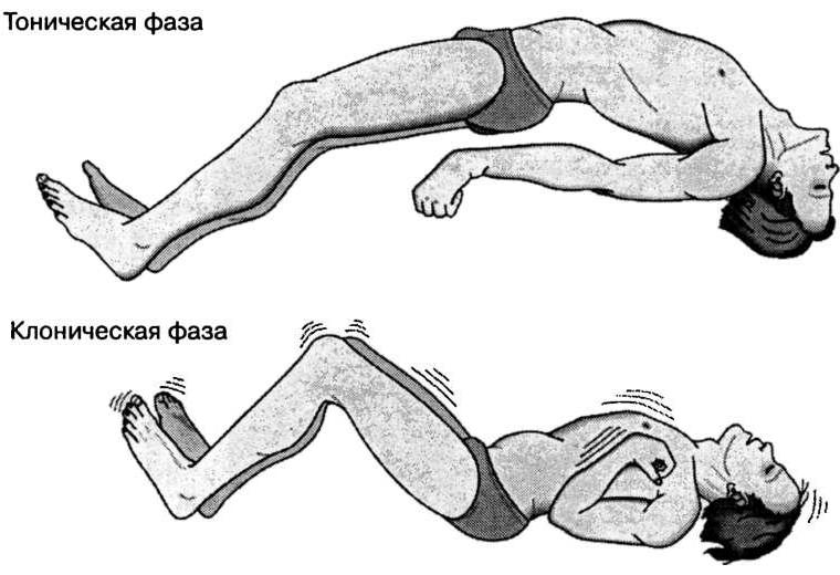 Приступ эпилепсии. Тоническая и клоническая фазы.