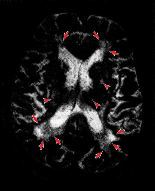 MPT-снимок головного мозга при сосудистой деменции