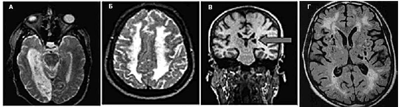 МРТ_картина поражения вещества головного мозга при СД (А – кортико-кортикальный окципито-темпоральный инфаркт; Б – Бинсвангеровский тип поражения субкортикального белого вещества; 