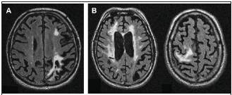 МРТ-признаки сосудистой деменции (А – множественные очаги ишемии слева, В – наличие обширного лейкоареоза и очага ишемии справа)