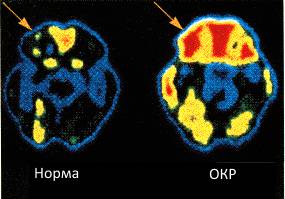 Активность головного мозга типичного человека с обсессмвно-комульсивным расстройством