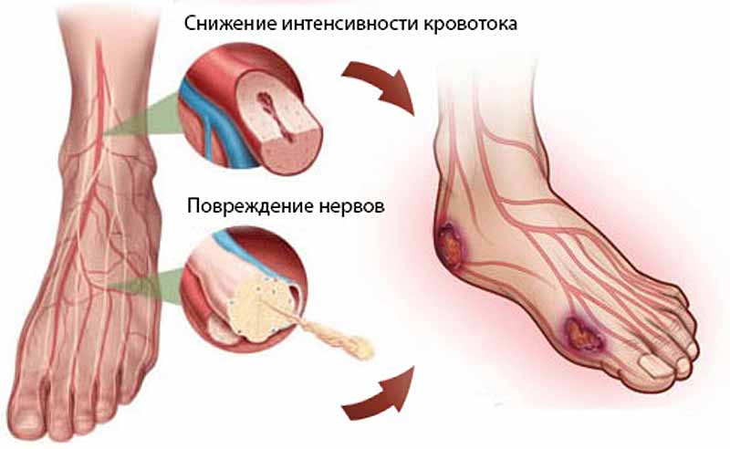 Полинейропатия нижних конечностей