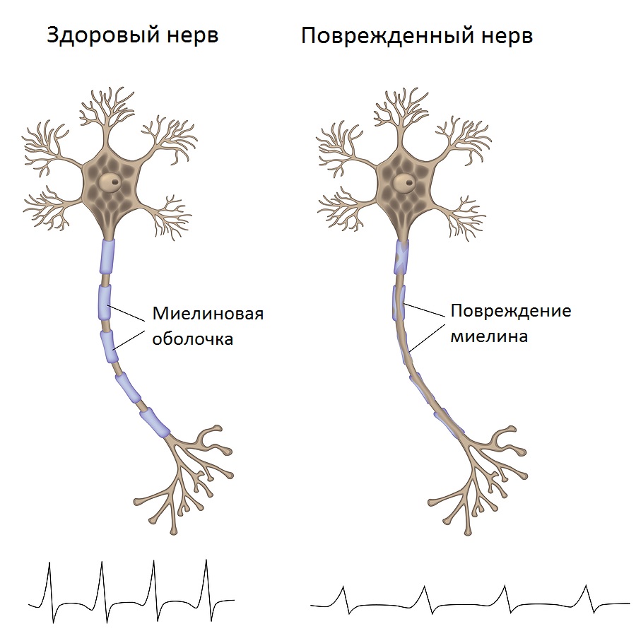 Поражение миелиновой оболочки нерва при полинейропатии.