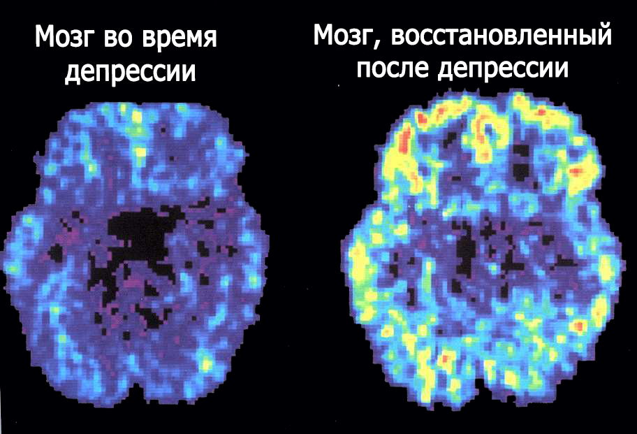 Снимок головного мозга во время депрессии и в восстановленном состоянии