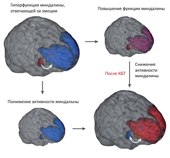 Синие области обозначают неактивную префронтальную область головного мозга во время острой депрессии, а красные области отображают увеличение миндалины, отвечающей за эмоции. Во время когнитивно-бихевиоральной терапии стимулируется префронтальная зона, таким образом, снижается активность миндалины и возникает эффект антидепрессанта. Впоследствии симптомы депрессии исчезают.