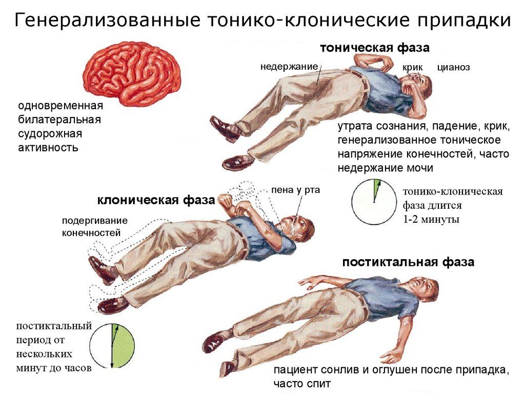 Как происходят припадки