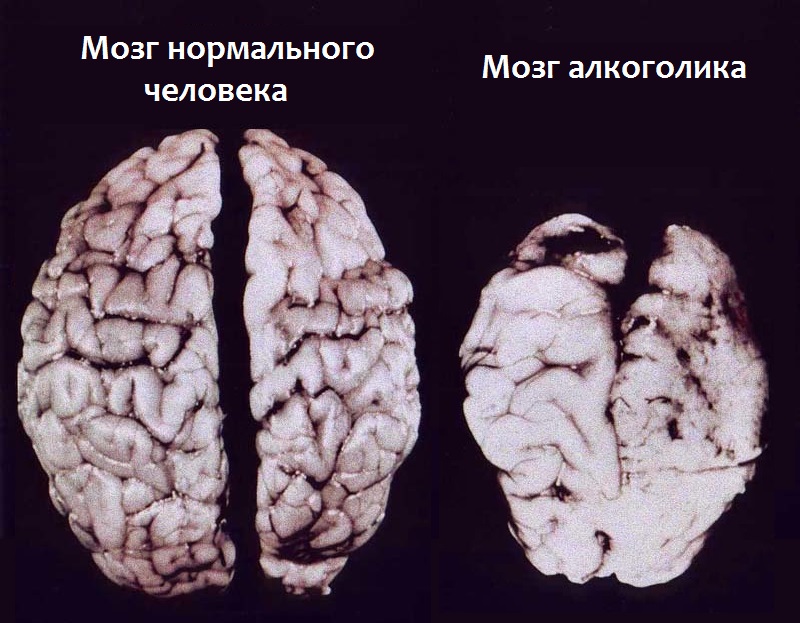 Фото человеческого мозга после вскрытия. Слева - здорового человека, справа - злоупотреблявшего алкоголем.