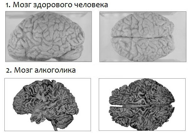 Влияние алкоголя на мозг человека.