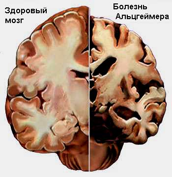 Головной мозг здорового человека и при болезни Альцгеймера