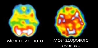 МРТ головного мозга здорового человека и психопата