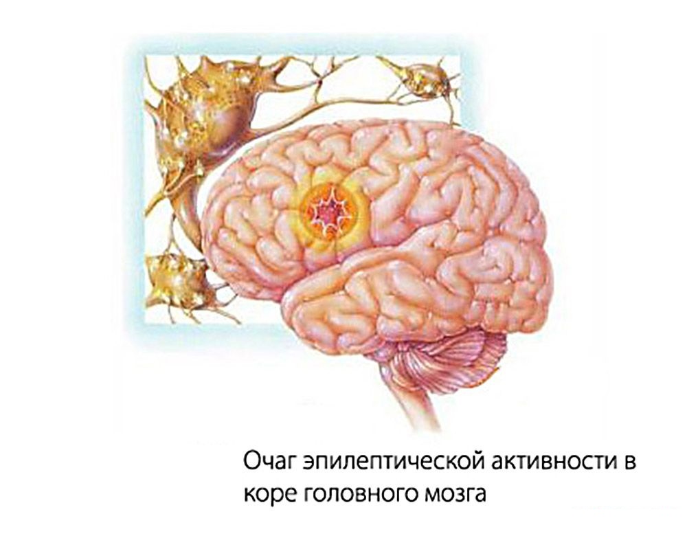 Очаг эпилептической активности пр фокальной эпилепсии