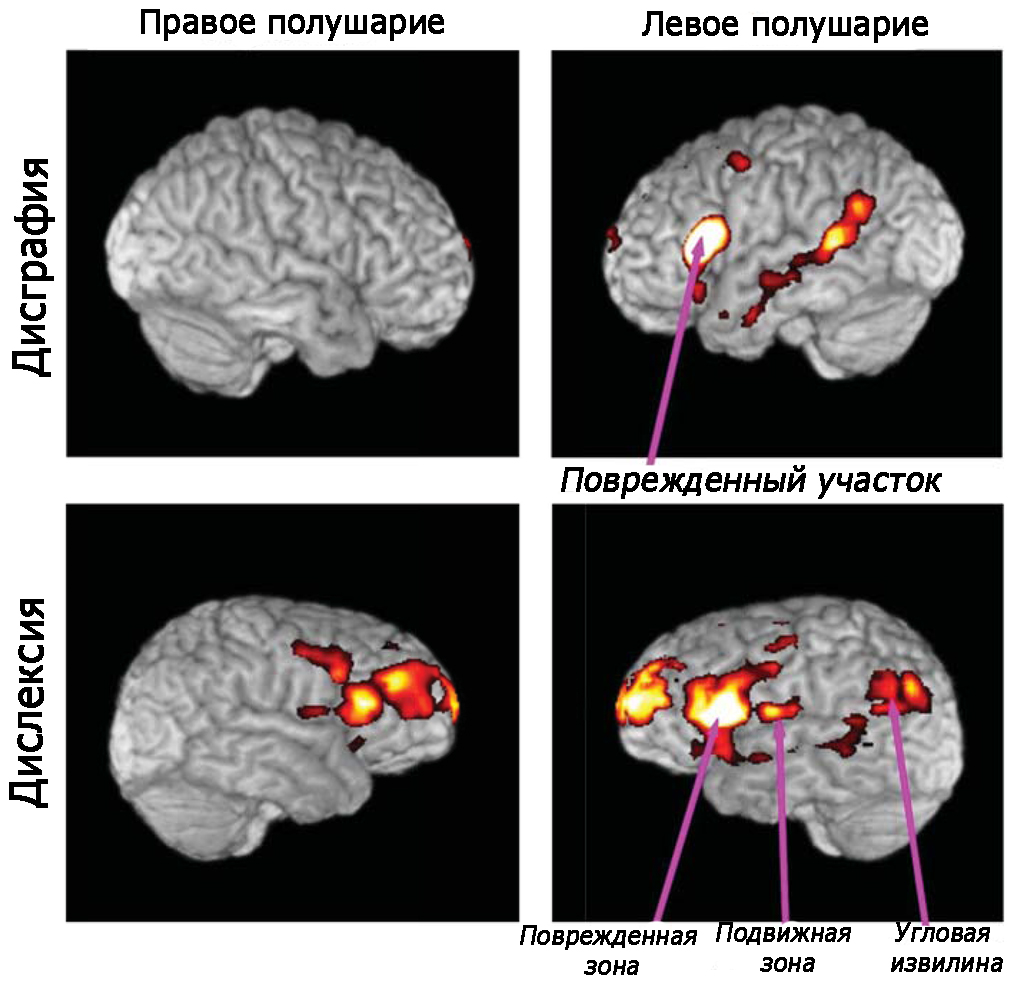 Пораженные участки мозга при дисграфии и дислексии