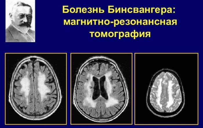 Болезнь Бинсвангера на МРТ