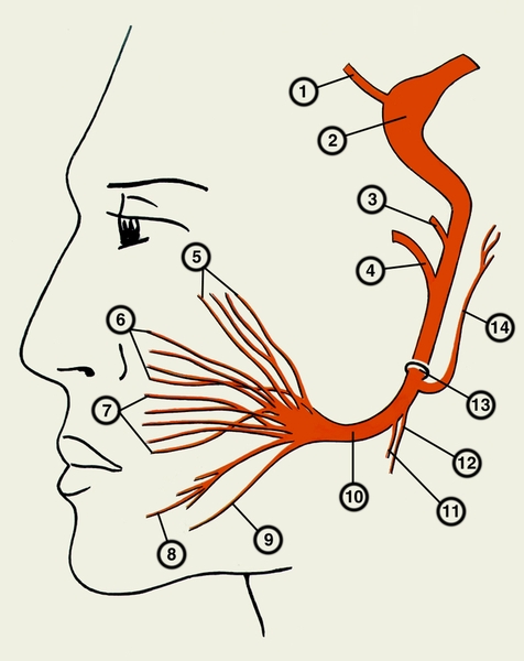 1 — большой каменистый нерв; 2 — ганглий коленца; 3 — стременной нерв; 4 — барабанная струна; 5 — височные ветви; 6 — скуловые ветви; 7 — щечные ветви; 8 — краевая ветвь нижней челюсти; 9 — шейная ветвь; 10 — околоушное сплетение; 11 — шилоподъязычная ветвь; 12 — двубрюшная ветвь; 13 — шилососцевидное отверстие; 14 — задний ушной нерв.
